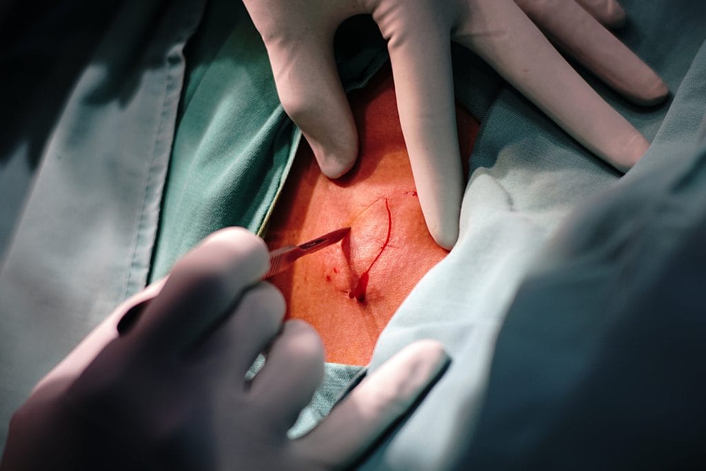 excisional surgery